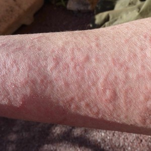 Hives (urticaria) are swollen, raised, red skin welts. Very often they ...