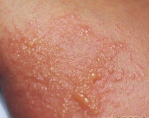 Eczema-atopic-dermatitis-picture