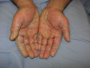 hand-contact-dermatitis-300x225